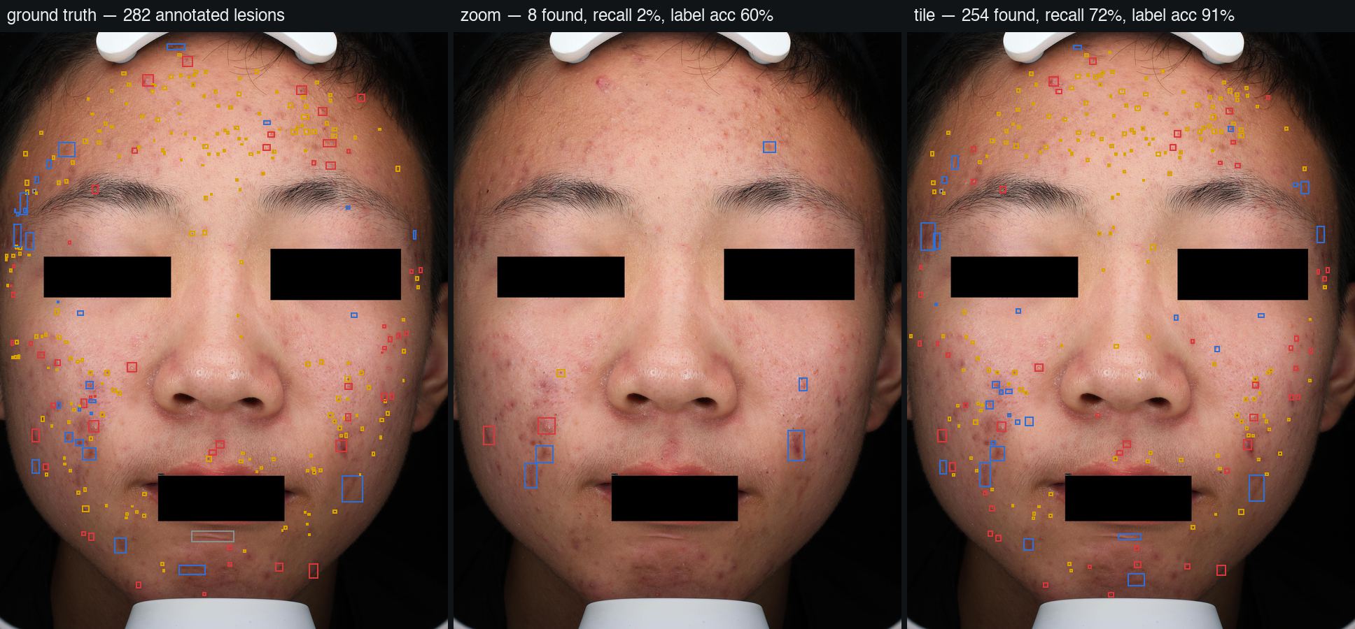 Side-by-side SkinScan test comparing full-image zoom with tiled analysis